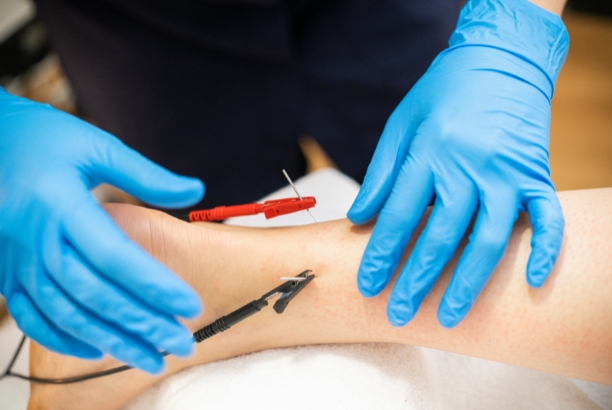 dry-needling-acupuncture